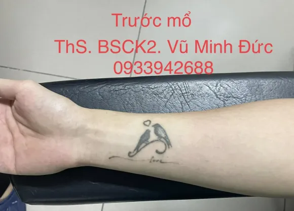 XÓA XĂM BẰNG PHẪU THUẬT GHÉP DA: GIẢI PHÁP 