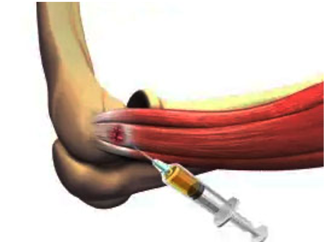 H&igrave;nh 3. Ch&iacute;ch PRP chứa tế b&agrave;o gốc