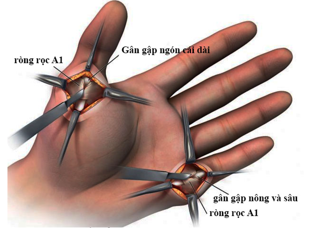Mổ cắt r&ograve;ng rọc A1 giải ph&oacute;ng g&acirc;n