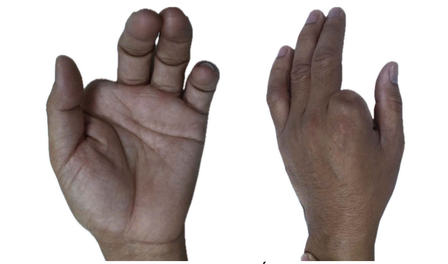 H&igrave;nh ảnh mất ng&oacute;n trỏ