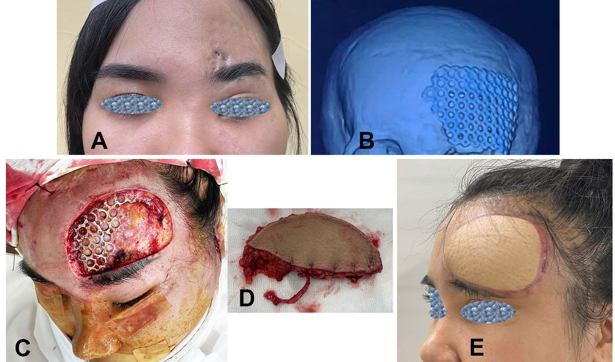 Vạt Đ&ugrave;i Trước Ngo&agrave;i che phủ lộ nẹp v&ugrave;ng tr&aacute;n