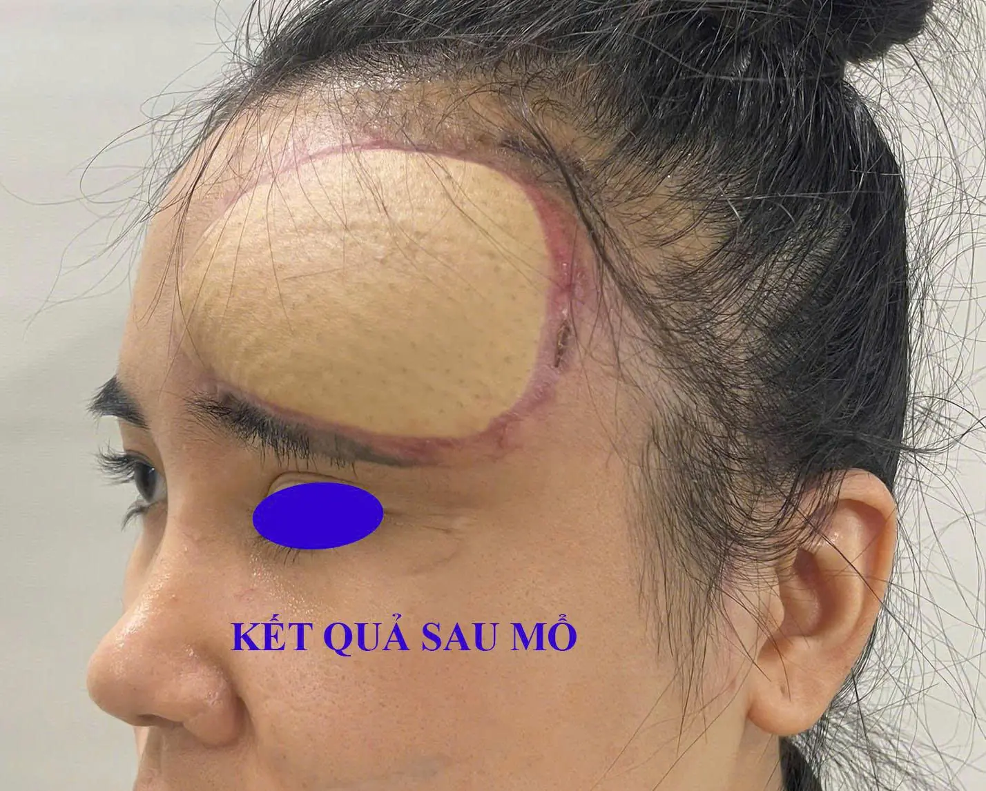 Tái Tạo Khuyết Hổng Vùng Trán Sau Tai Nạn Bằng Vạt Đùi Trước Ngoài